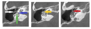 CBCT for Temporal Bones - The New Gold Standard - Cavendish Imaging