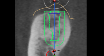 Mon 27 Mar ’17: CBCT in Periodontics