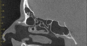 Mon 27 Feb ’17: CBCT for Paranasal Sinuses