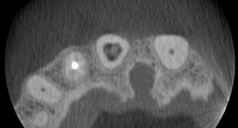 Wed 17 May '17: CBCT Interpretation - Small Volumes