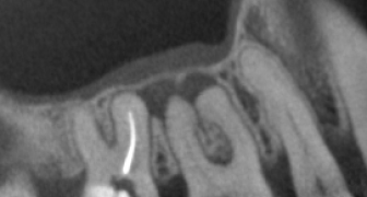 Tue 18 Apr ’17: CBCT in Endo