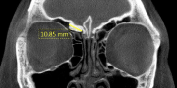 Exploring the Role of Dental CBCT in ENT: A Revolutionary Tool for Enhanced Diagnosis and Treatment