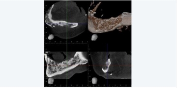 Case Study: Extensive Permeative Bone Loss