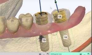 Guided Surgery in Dentistry: Precision and Innovation
