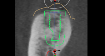 Mon 24 Apr ’17: Guided Surgery