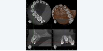 Case Study: how many denticles?