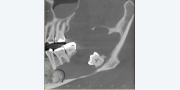 Case Study: Interesting LLQ Cyst