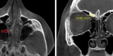 Unlocking the Secrets of Paranasal Sinuses with Cone Beam CT scans.