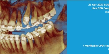 Explore Custom 3D Surgical Guides